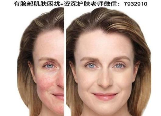我的臉過敏了怎么辦啊?臉過敏后毛孔粗大如何解決?