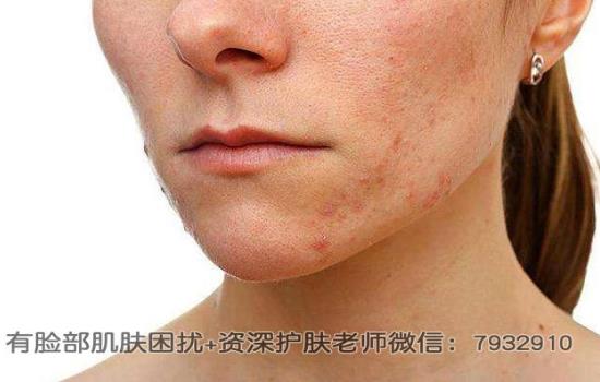 我的臉過敏了怎么辦。磕樳^敏后毛孔粗大如何解決?