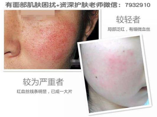 熬夜臉上有紅血絲咋辦?紅血絲能徹底去除嗎?