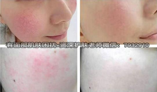 熬夜臉上有紅血絲咋辦?紅血絲能徹底去除嗎?