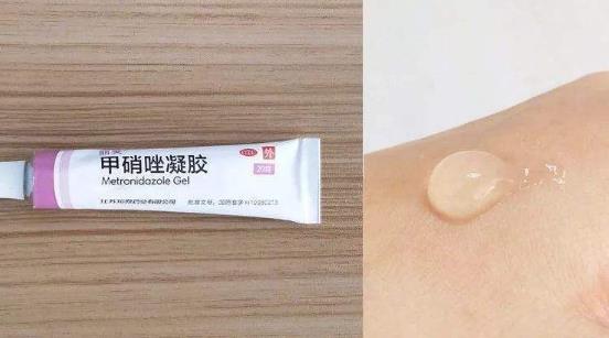 甲硝唑凝膠可以去痘痘嗎?甲硝唑凝膠的作用有哪些?