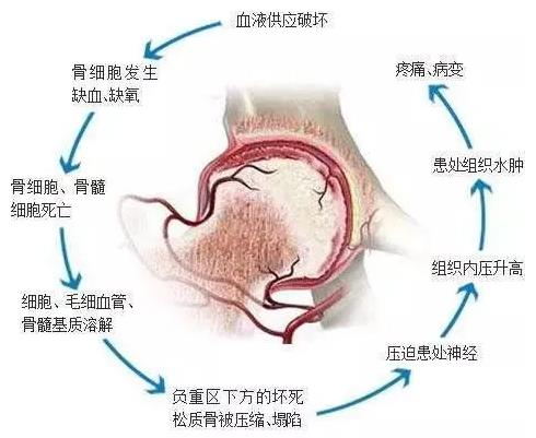 中藥能治好股骨頭壞死?素樸中醫(yī)院通血生骨方純中醫(yī)療法有何妙法?