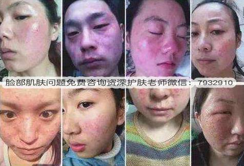 激素臉多久可以恢復(fù)?教你如何改善激素臉