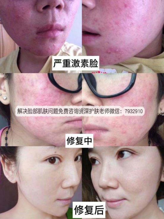 激素臉怎么辦能好嗎?過敏性皮炎和激素臉有什么區(qū)別?