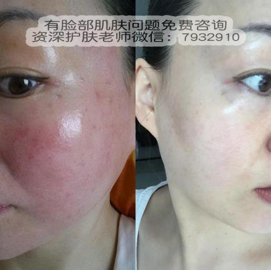 激素臉長痘痘了怎么辦?對抗激素臉有什么好辦法?
