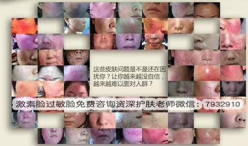 激素臉多久可以恢復(fù)?教你如何改善激素臉