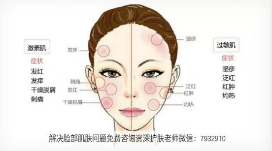 激素臉怎么辦能好嗎?過敏性皮炎和激素臉有什么區(qū)別?