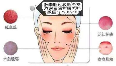 激素臉多久可以恢復(fù)?教你如何改善激素臉