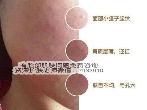 激素臉長痘痘了怎么辦?對抗激素臉有什么好辦法?