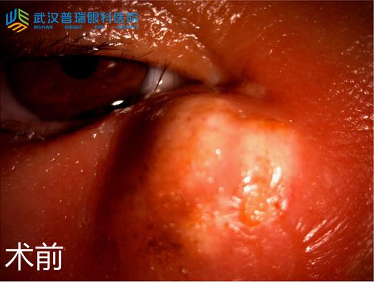 眼角疼還脹起膿包 慢性淚囊炎發(fā)作嚇壞六旬阿姨
