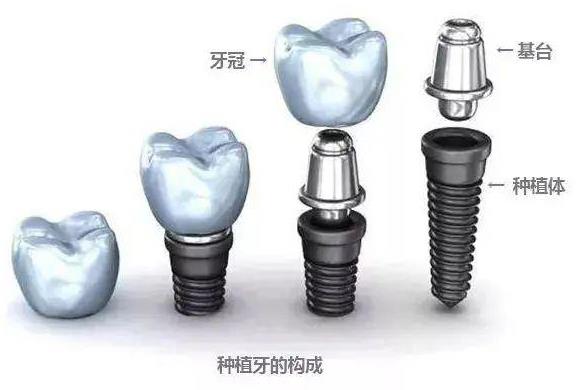 全民愛牙公益行動(dòng) 老年人公益種牙有保障
