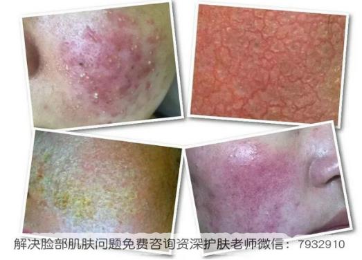 激素臉有哪些癥狀?激素臉的治療方法哪種好?