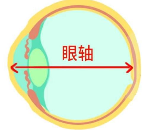 北京茗視光眼科:眼軸增長(zhǎng)1mm孩子近視就增加300度嗎?
