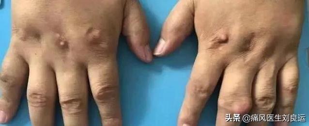 成都西部痛風(fēng)風(fēng)濕醫(yī)院靠譜嗎?技術(shù)精湛 正規(guī)靠譜