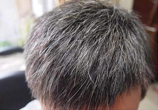 吃黑芝麻對(duì)脫發(fā)有用嗎,看看你是不是沒(méi)有吃對(duì)!