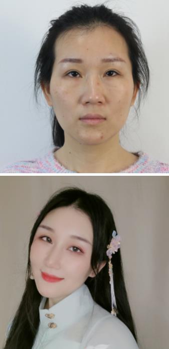 福州名韓整形徐麗麗:早點(diǎn)做脂肪膠填充的好處