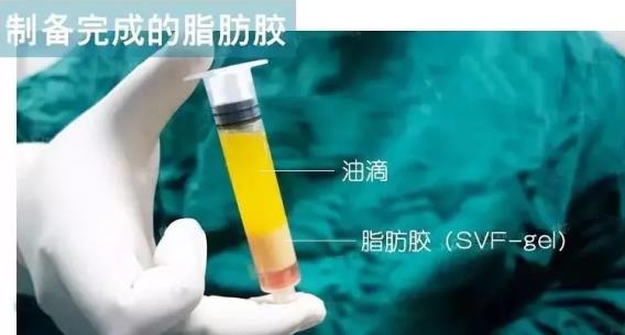 福州名韓整形徐麗麗:早點(diǎn)做脂肪膠填充的好處