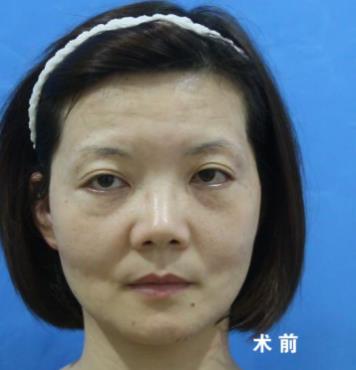 福州名韓整形徐麗麗:早點(diǎn)做脂肪膠填充的好處