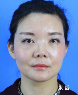 福州名韓整形徐麗麗:早點(diǎn)做脂肪膠填充的好處
