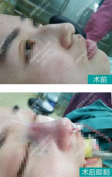 武漢愛思特楊水斌矯正大鼻頭效果怎么樣?技術(shù)好嗎?