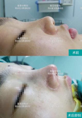 武漢愛思特楊水斌矯正大鼻頭效果怎么樣?技術(shù)好嗎?
