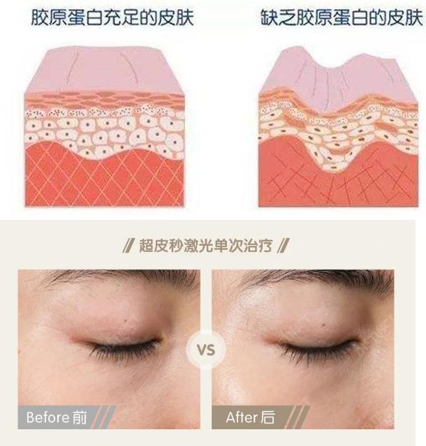 超皮秒激光在眼周年輕化的作用——石榴醫(yī)療美容醫(yī)院李月萍院長(zhǎng)