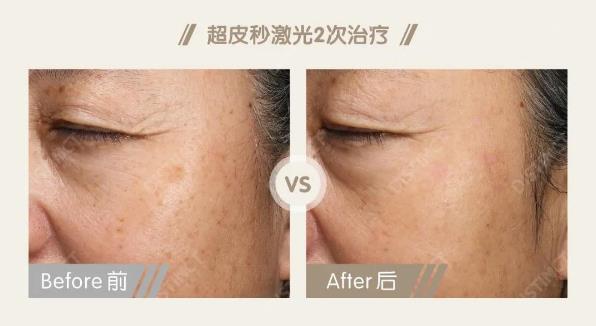 超皮秒激光在眼周年輕化的作用——石榴醫(yī)療美容醫(yī)院李月萍院長(zhǎng)