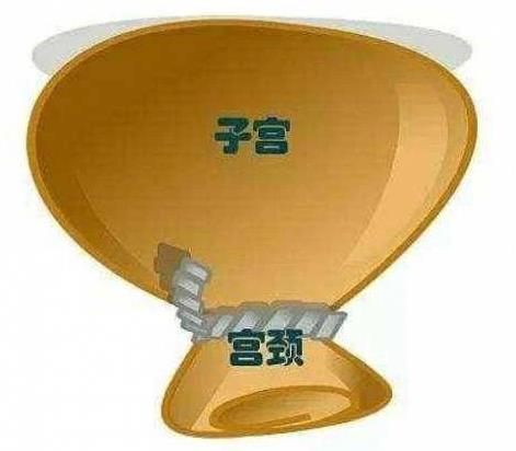 鄭州美中商都婦產(chǎn)醫(yī)院宮頸機(jī)能不全精準(zhǔn)保胎之宮頸環(huán)扎術(shù)成功案例!