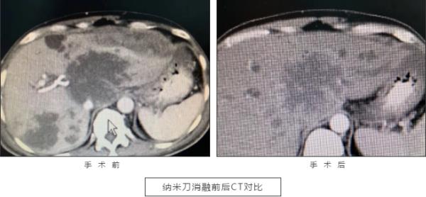 西藏腫瘤醫(yī)院認準廣州復大腫瘤醫(yī)院:納米刀治癌,圓患者重生夢