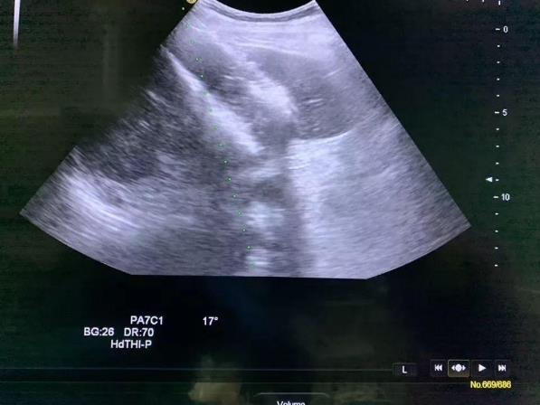 西藏腫瘤醫(yī)院認準廣州復大腫瘤醫(yī)院:納米刀治癌,圓患者重生夢