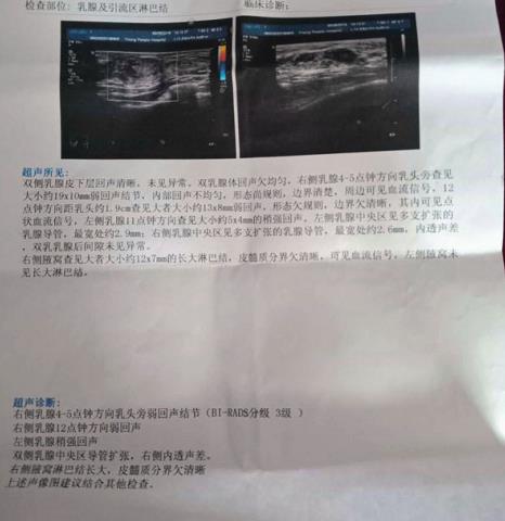 我是如何和乳腺增生結節(jié)進行抵抗并且勝利的