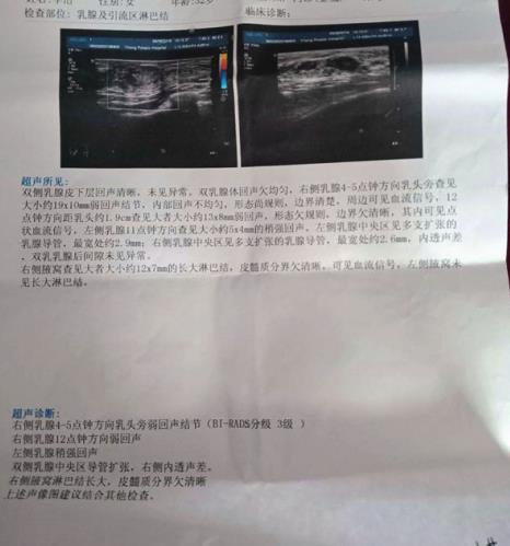 【分享】讓我痛苦多年的乳腺增生竟然這么輕松就好了