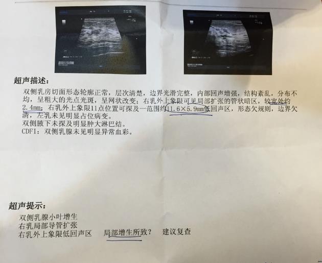 早知道乳腺增生這么容易就能好 我還TMD做什么手術(shù)啊!胸部都割爛了!