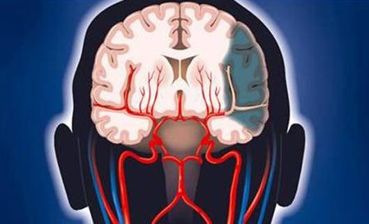 腦血栓的早期癥狀是什么?腦血栓會(huì)引起哪些并發(fā)癥?