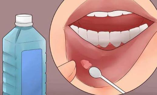 口腔潰瘍是怎么引起的?口腔潰瘍?cè)趺崔k?