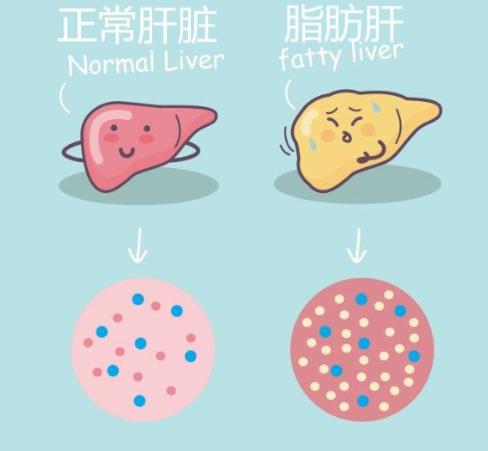 患上脂肪肝怎么辦?脂肪肝吃什么中藥好