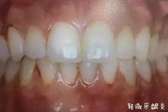 為什么說牙病要及時(shí)醫(yī)治——全民愛牙公益行動(dòng)