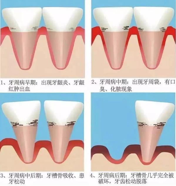 為什么說牙病要及時(shí)醫(yī)治——全民愛牙公益行動(dòng)