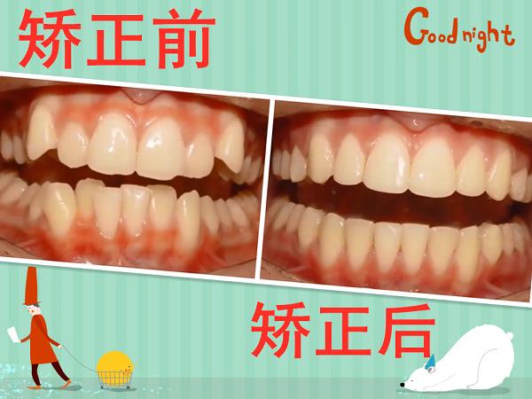 牙齒矯正前要做哪些準(zhǔn)備?昆明德韓口腔為您解答!