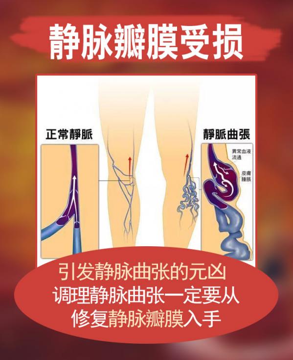 牢記下肢靜脈曲張生活禁忌,平復(fù)曲張用曲康健非常管用