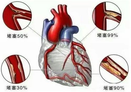 杭州怡養(yǎng)醫(yī)院發(fā)聲:年輕人,你離心腦血管疾病沒多遠!