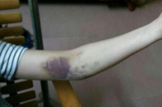 淤青與白血病有什么關(guān)系?怎么快速消除淤青?