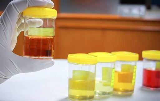 尿液發(fā)白是糖尿病嗎?出現(xiàn)白色尿液的原因有哪些?