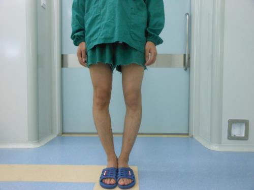 我的O型腿矯正經(jīng)歷