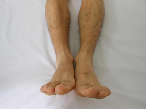 我的O型腿矯正經(jīng)歷
