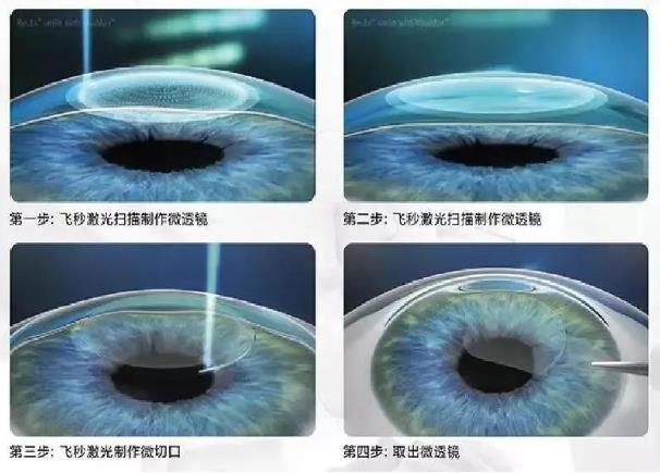 全飛秒手術(shù)切口小、安全性高、恢復(fù)快,是真的嗎?