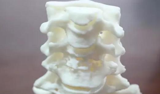 頸椎結(jié)核會(huì)有哪些后遺癥?頸椎結(jié)核有哪些癥狀?