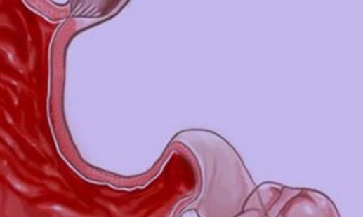 潰瘍性結(jié)腸炎有哪些并發(fā)癥?潰瘍性結(jié)腸炎需要做哪些檢查?