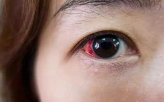 患前房積血的原因有哪些?前房積血的并發(fā)癥
