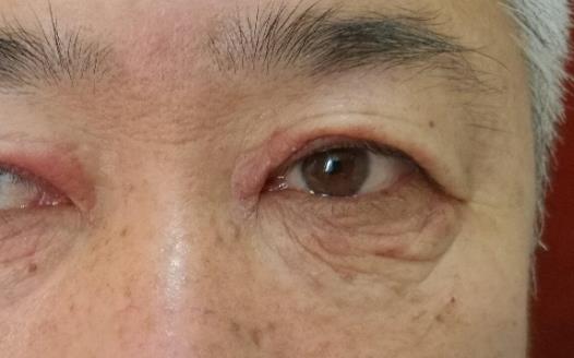 哪些人易患淚液分泌過(guò)多?淚液分泌過(guò)多有哪些并發(fā)癥?